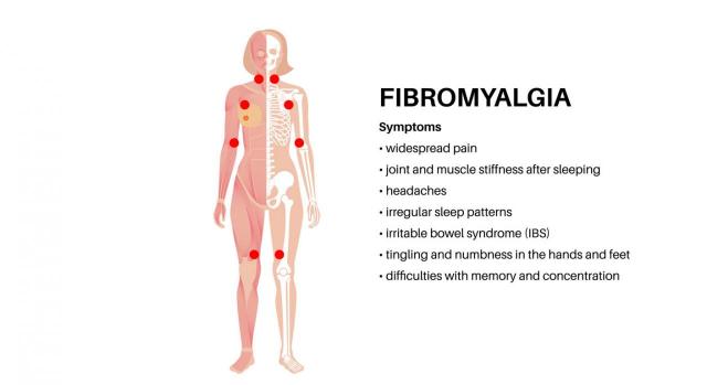 La fibromialgia sigue sin ser por sí misma una enfermedad discapacitante. No cabe juzgar con perspectiva de género, aunque se presente mayoritariamente en las personas de sexo femenino. Imagen del cuerpo de una mujer señalando los puntos que se fijan la fibromialgia